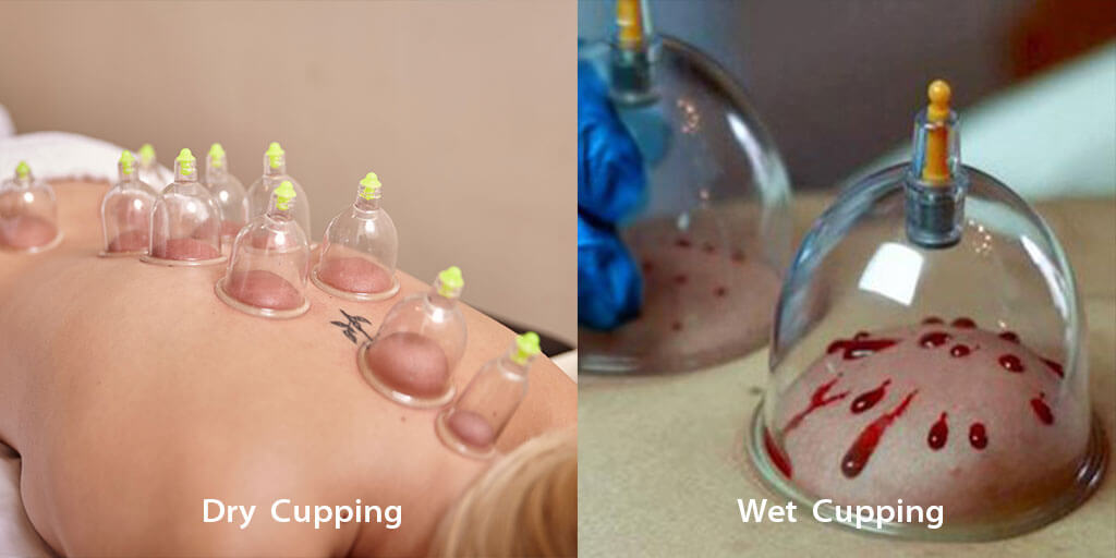  Healing Plus Wet Cupping Session 60 MinutesNutrition Plus